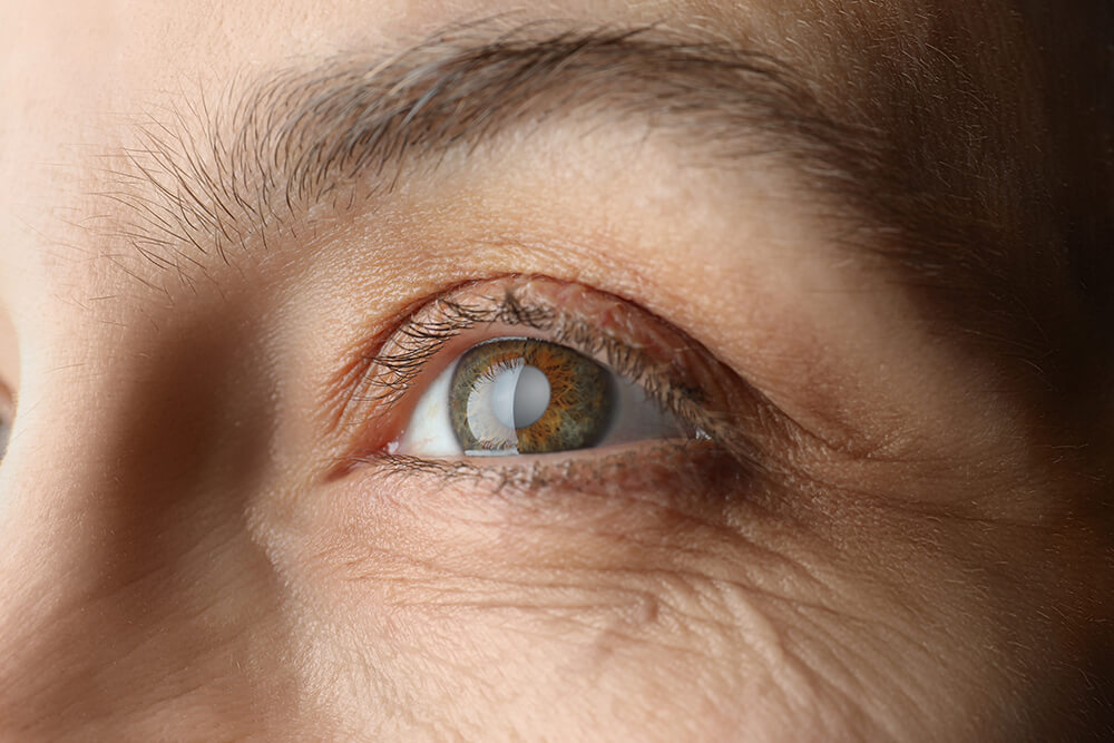 Nahaufnahme eines Auges mit getrübter Linse und braun-grüner Iris