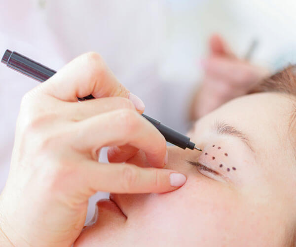 Nahaufnahme einer Hand, die mit einem Stift Markierungen auf ein geschlossenes Augenlid setzt